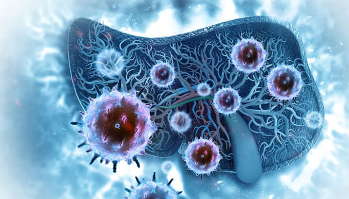 livercancer