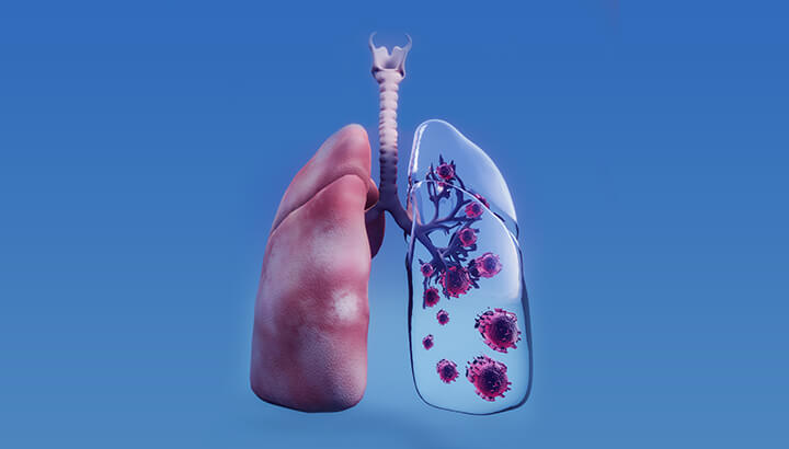 lungcancer