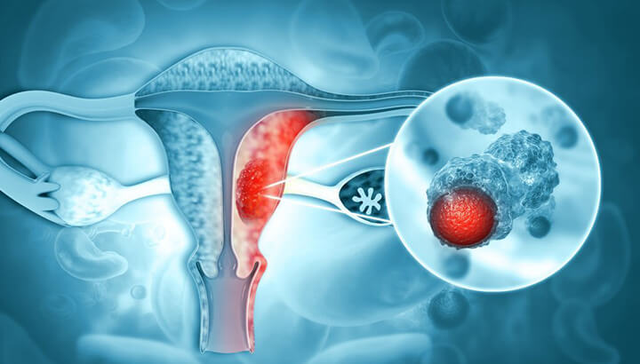 ovariancancer